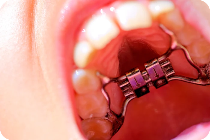 Disjoncteur orthodontique fixé sur les molaires supérieures d’un enfant