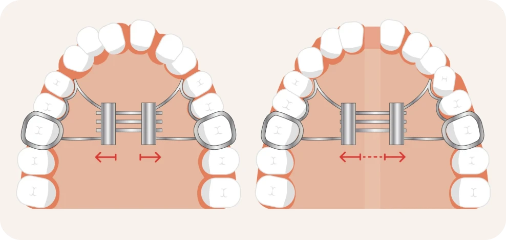 Schéma montrant l’élargissement du palais par un disjoncteur orthodontique