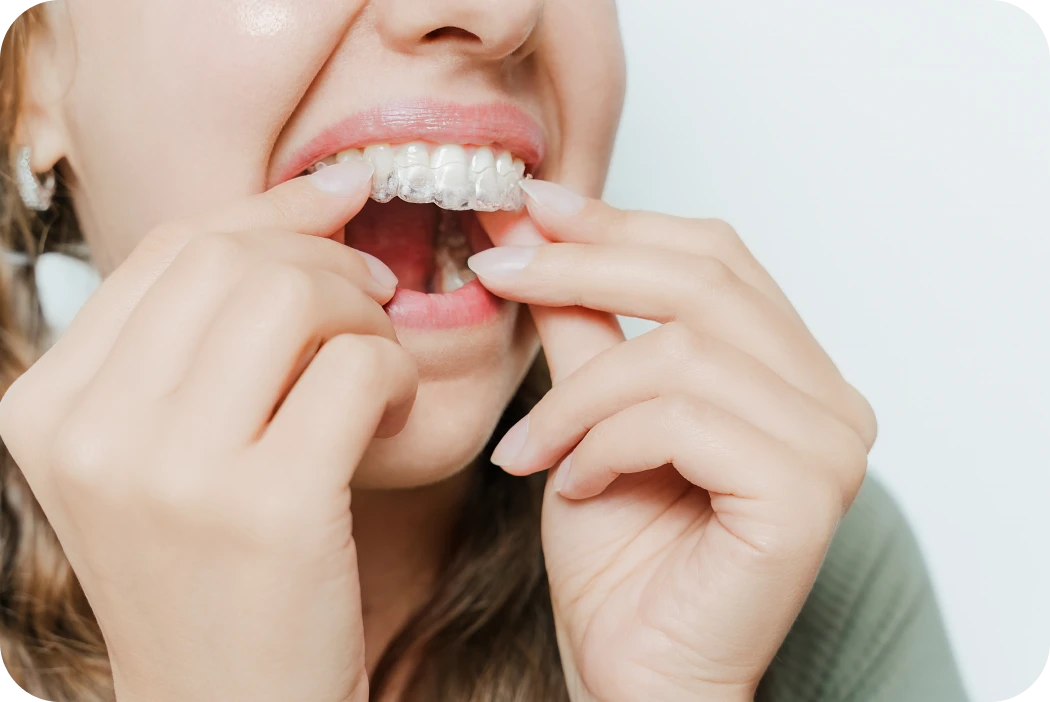 Gros plan sur la pose d'un aligneur transparent sur les dents
