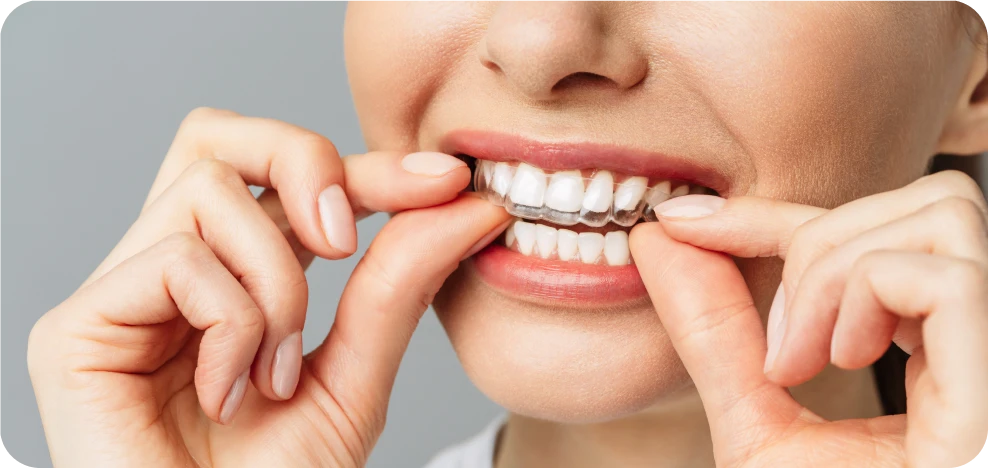 Femme mettant en place un aligneur transparent sur ses dents