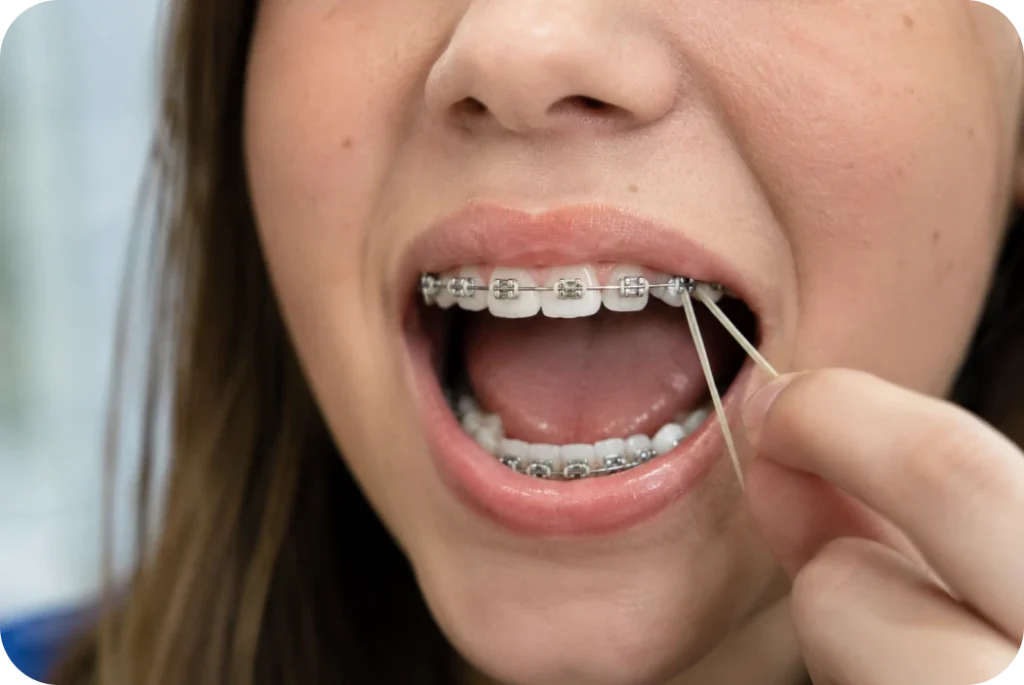Adolescente plaçant elle-même un élastique intermaxillaire sur son appareil dentaire