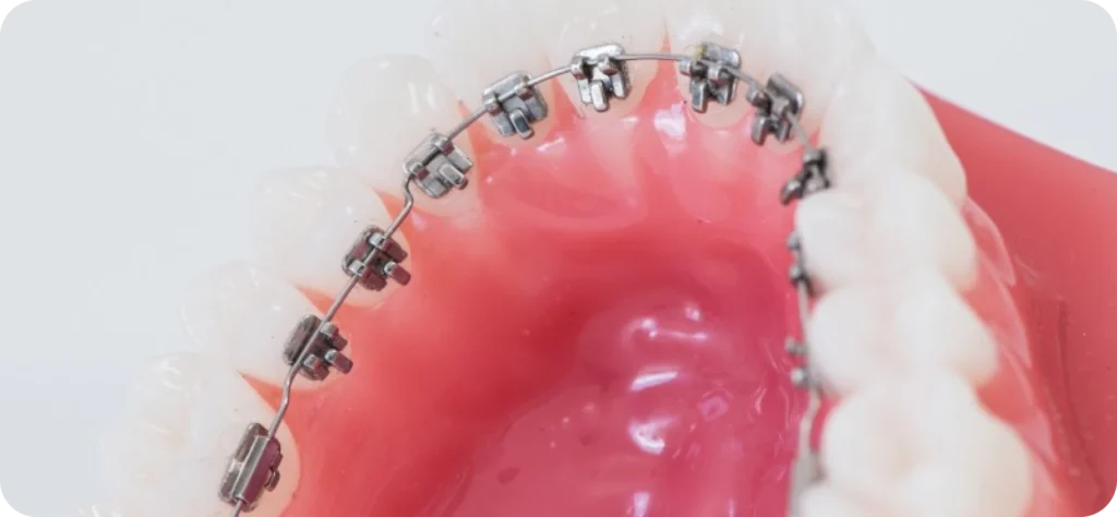 Gros plan sur un appareil orthodontique lingual fixé à l'arrière des dents