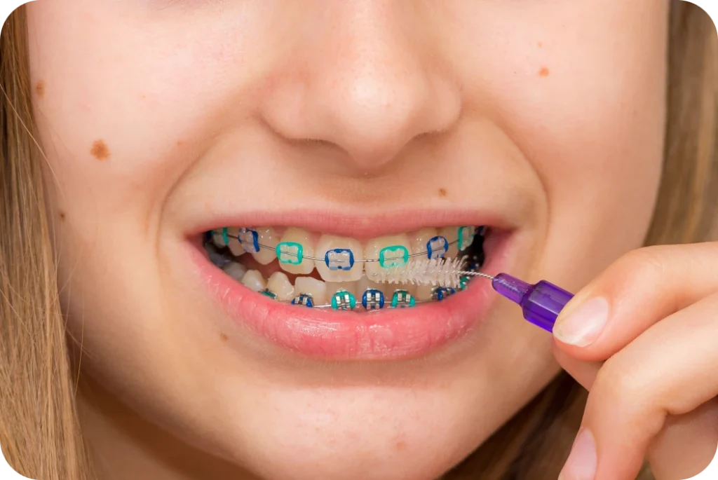 Brossage interdentaire d'un appareil orthodontique avec élastiques intermaxillaires