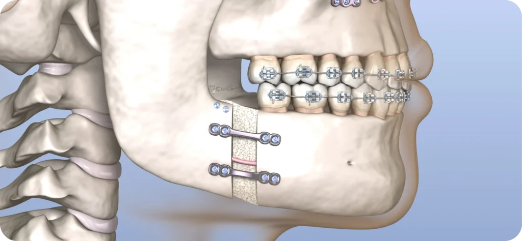 Illustration 3D d'une chirurgie orthognathique de la mâchoire