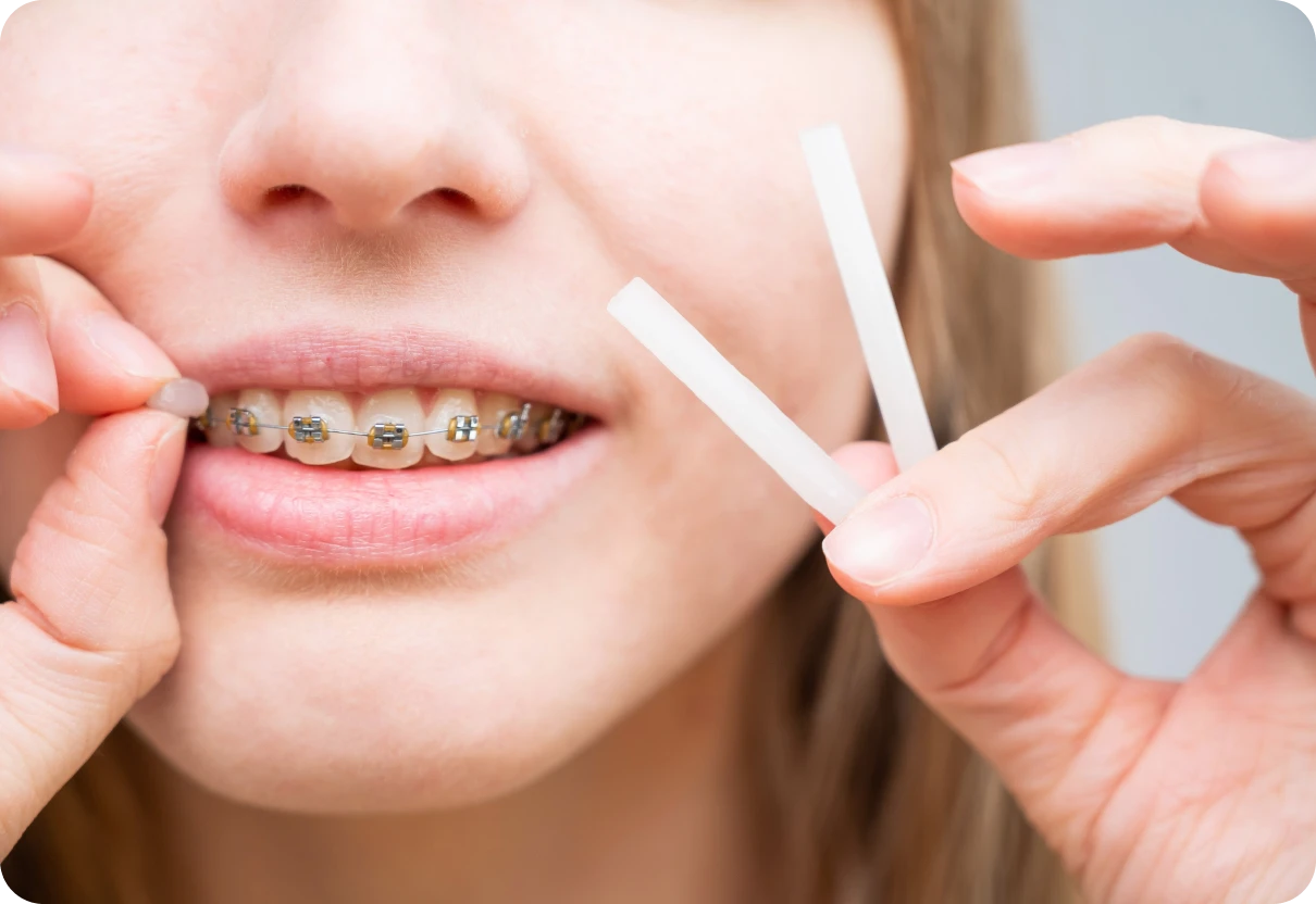 Application de cire orthodontique pour soulager l'irritation causée par un arc blessant