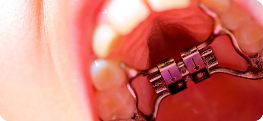 Disjoncteur orthodontique en place sur le palais d'un enfant