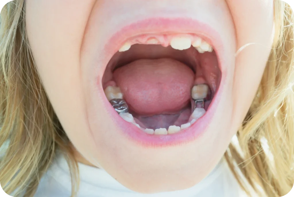 Mainteneur d’espace visible dans la bouche d’un enfant après la perte d’une dent