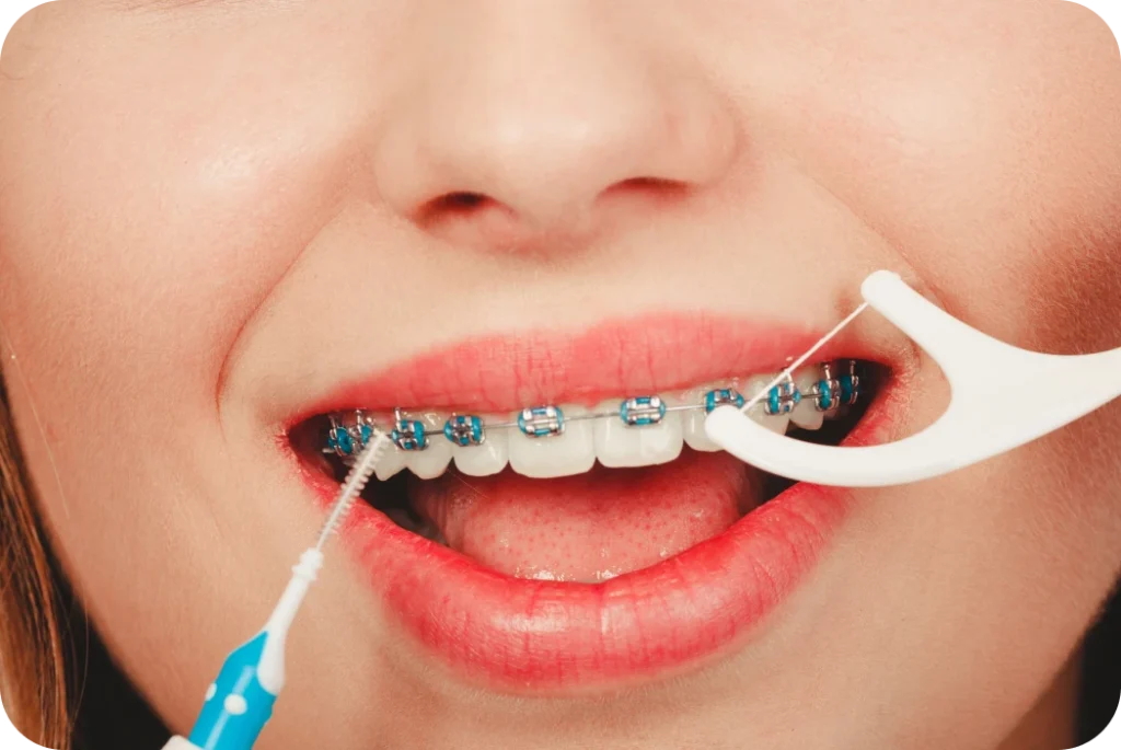 Nettoyage autour des attaches orthodontiques avec une brossette interdentaire