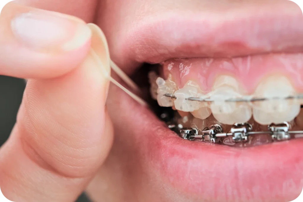 Mise en place d'un élastique intermaxillaire sur un appareil dentaire